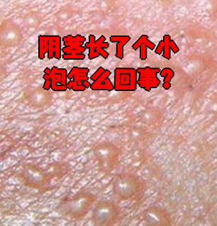 阴茎上长小泡可能和阴囊湿疹,生殖器疱疹,龟头炎这些情况有关