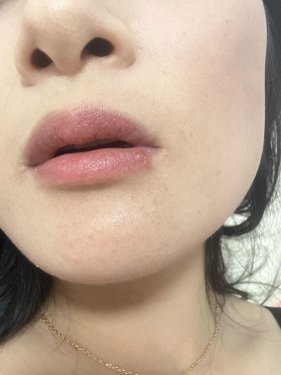 嘴唇账疱疹 用这药 简直神器 昨天晚上发了个疱疹 就立马找百度 买到