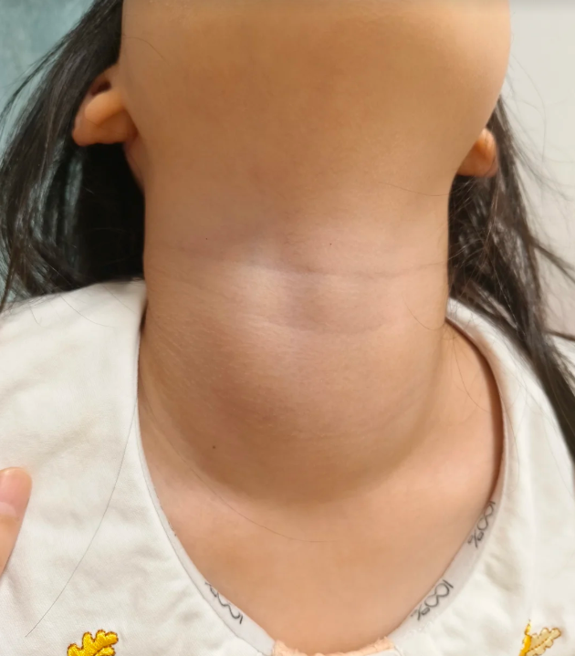 甲状腺充血肿大时,首先需明确其病因,可能原因包括放射性碘摄取灌多