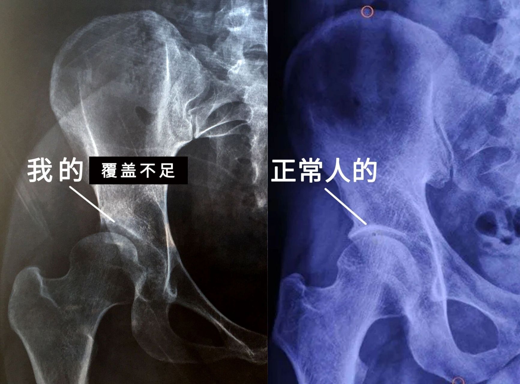 先天性髋臼发育不良,髋臼不能很好地覆盖股骨头,使得髋关节不稳定