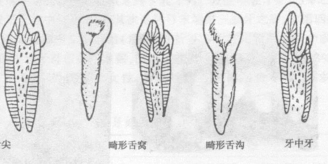 舌隆突图片