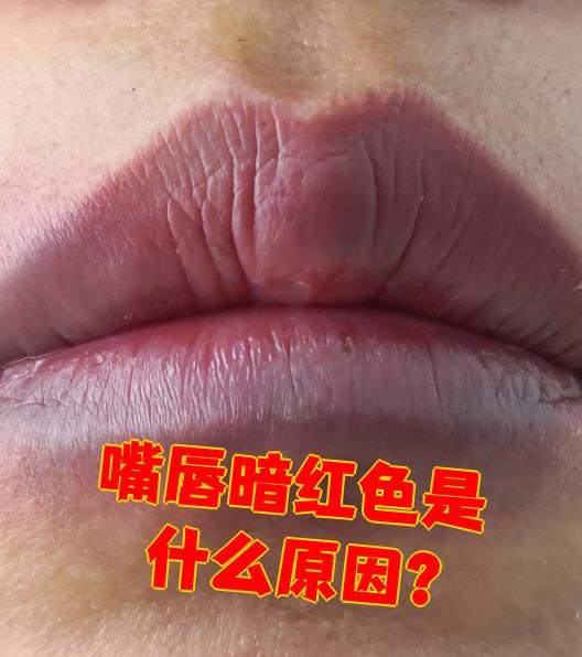每个人的皮肤和粘膜颜色本来就有差异,所以唇色深浅不同是正常的