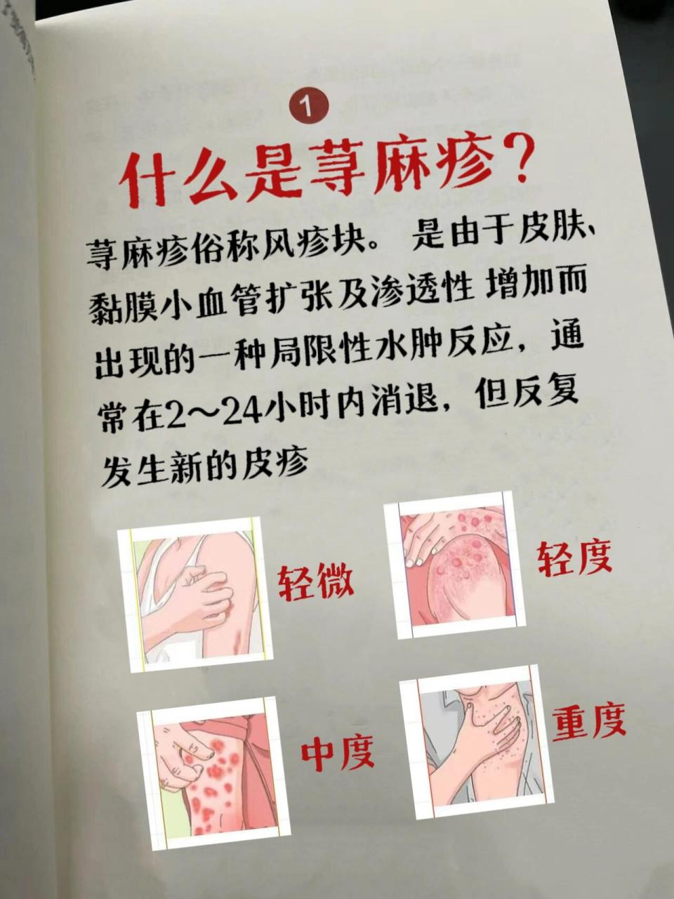 荨麻疹忌口 荨麻疹俗称风疹块.