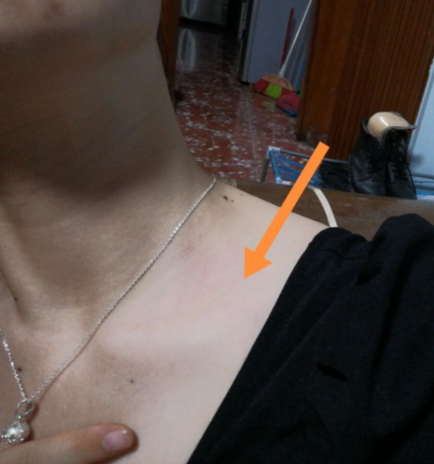 锁骨上有硬的骨头凸起怎么回事?