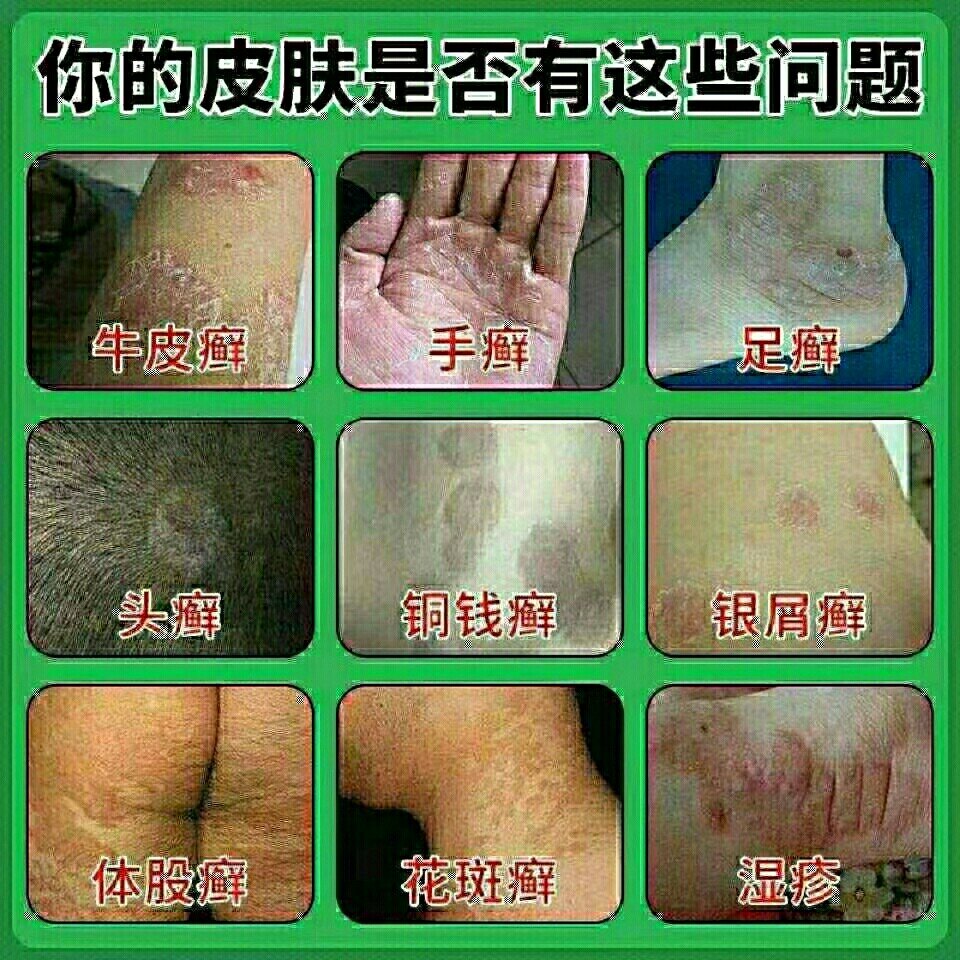 专门治疗皮肤病,祖传秘方药膏