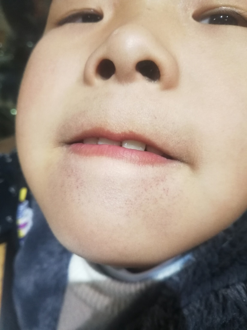 孩子的上下嘴唇周围都是红色的小点点,这是什么情况