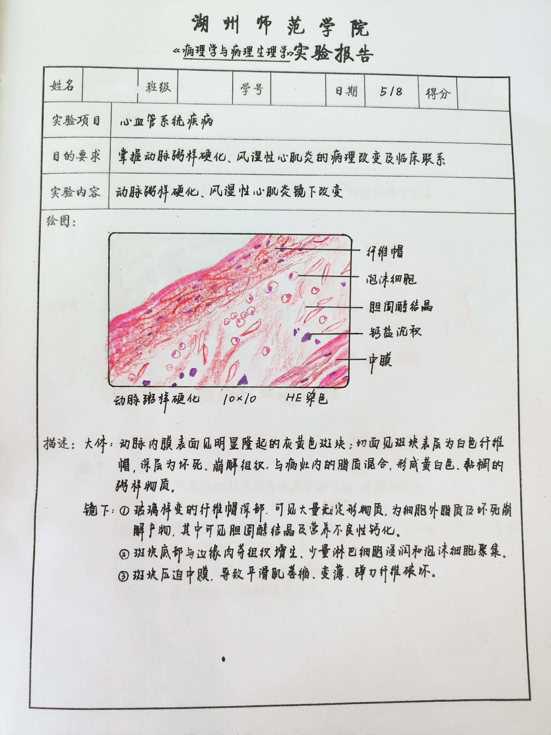 肾浊肿手绘实验报告图图片