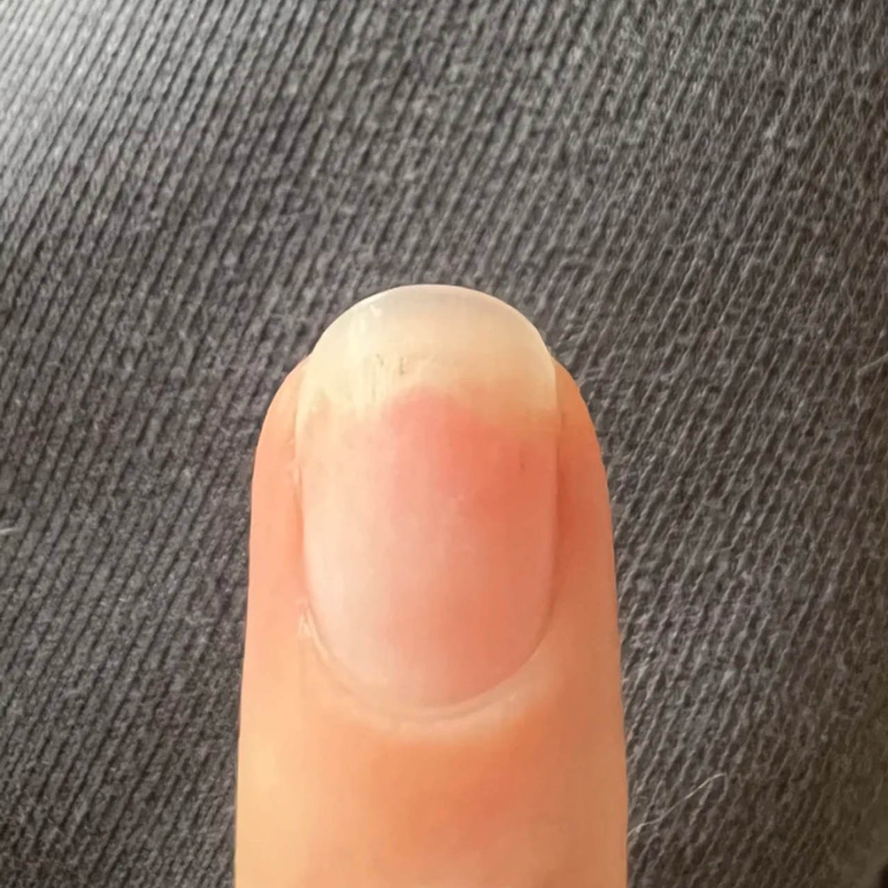 指甲缝一条白的,空甲怎么办?