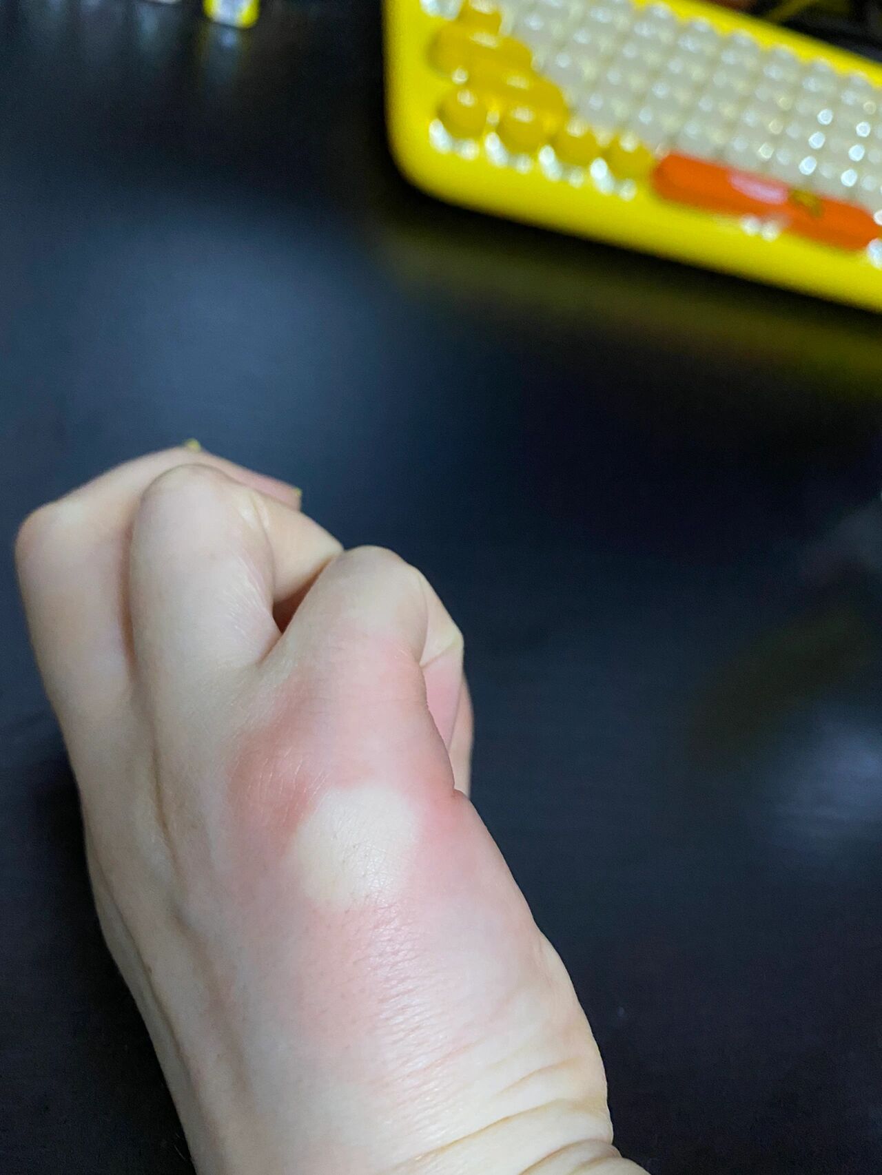 被会飞的蚂蚁🐜🦟咬了一口!太疼了😩