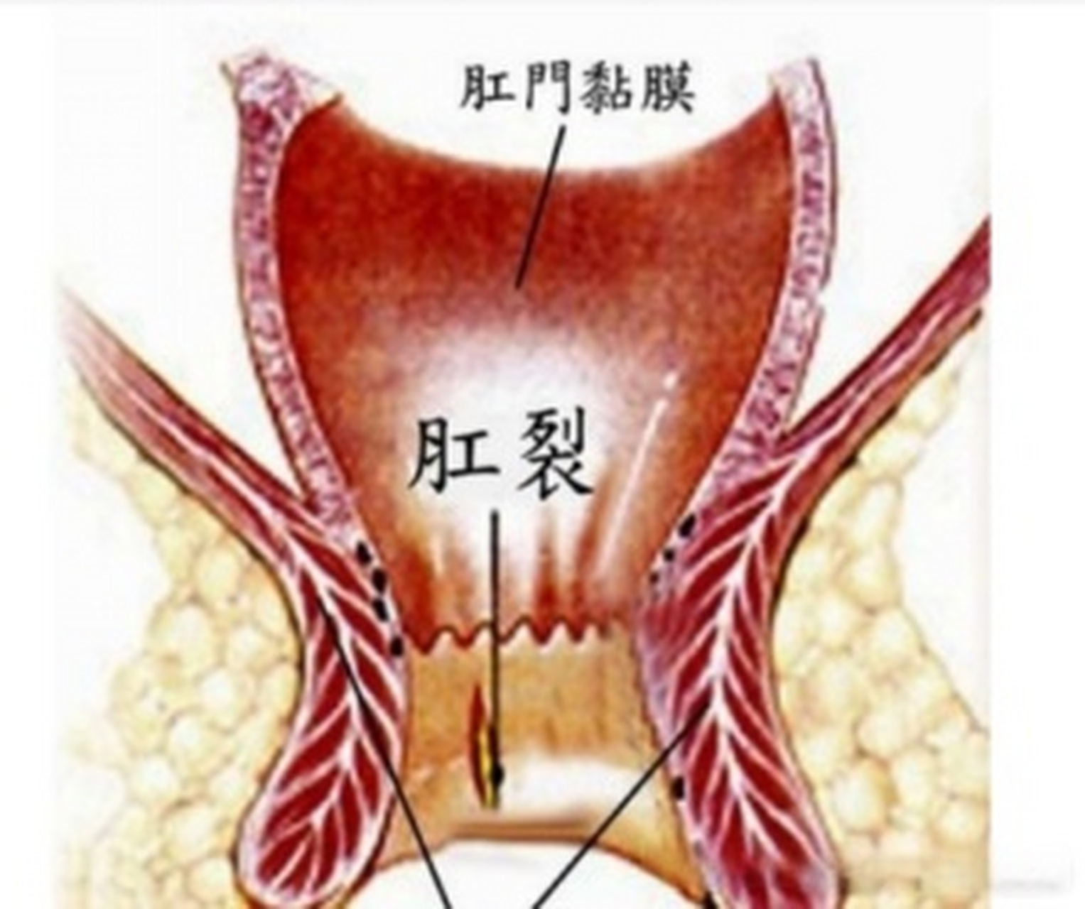 肛裂 毁三观图片