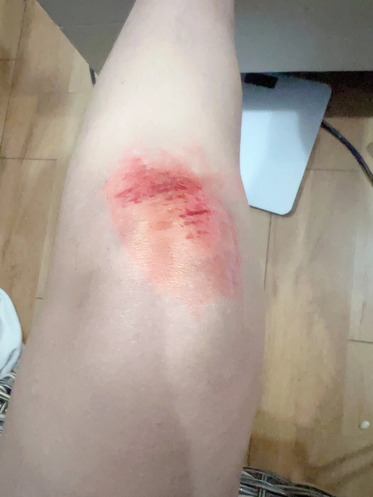 为什么骑车每次摔了都是膝盖破