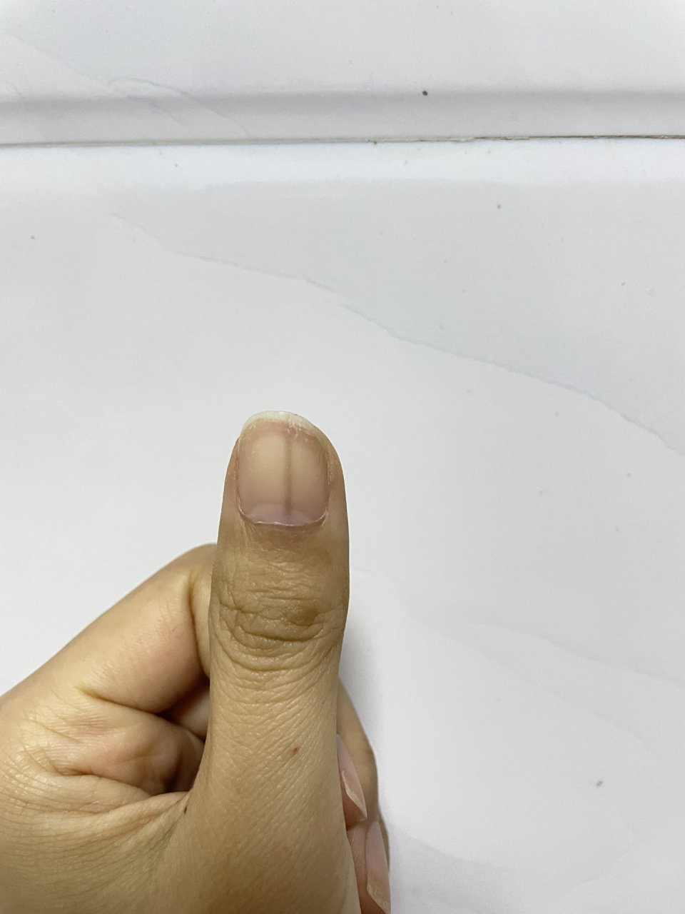 指甲上为什么会有黑线呢 今天突然发现自己大拇指中间有一条黑线,以前