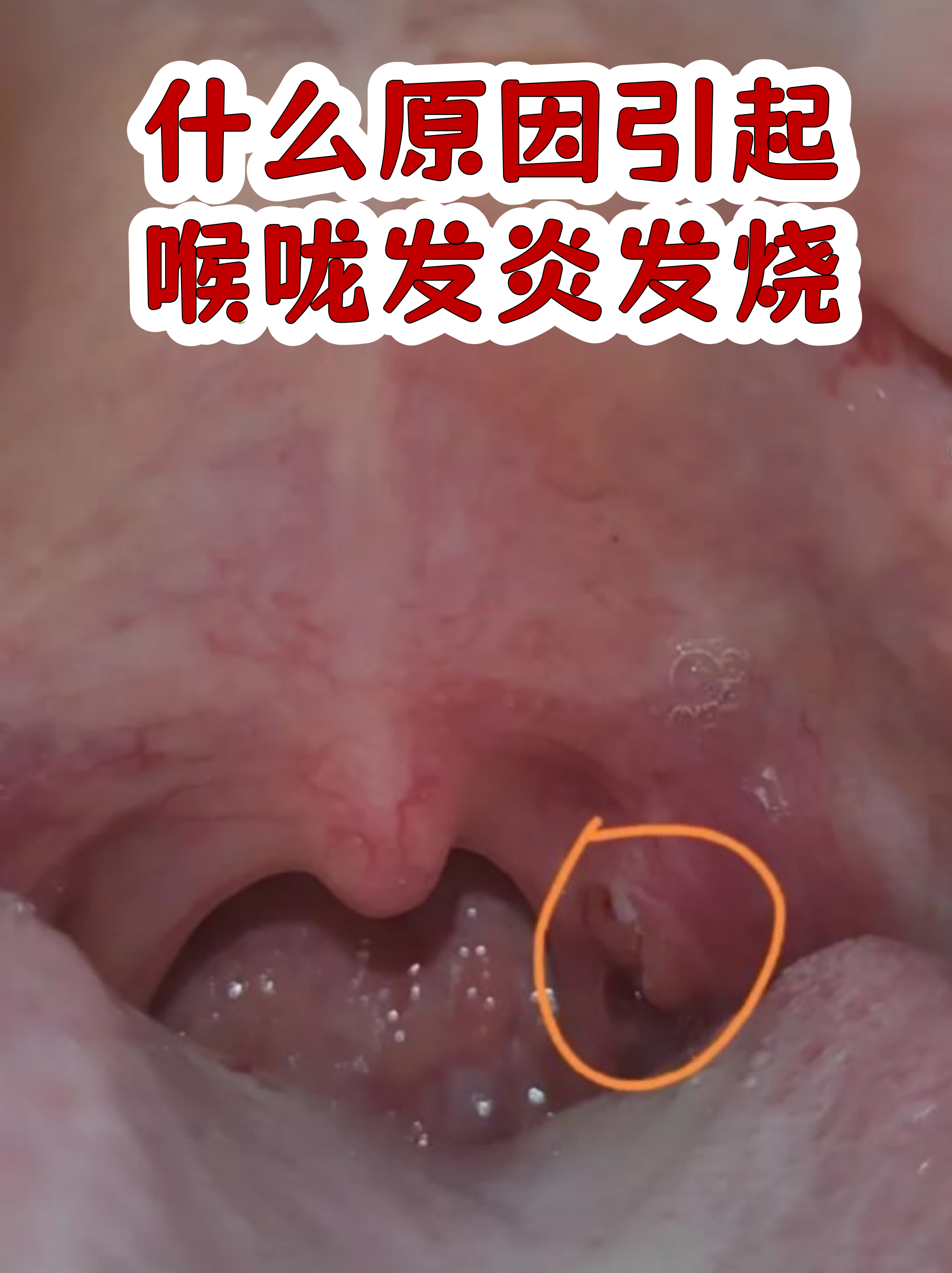  病毒感染的喉咙发炎怎么办(病毒感染引起的喉咙痛吃什么药)