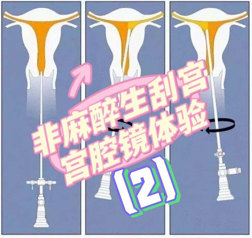 北京妇产医院非麻醉生刮宫宫腔镜体验和流程 接上篇"北京妇产医院非