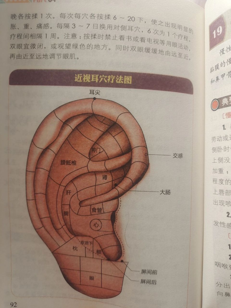 贴耳豆减肥的位置图片图片