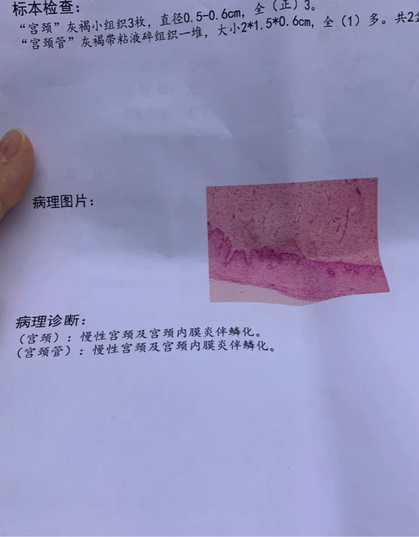 孕39周出现一坨褐色果冻分泌物,这通常是宫颈粘液栓