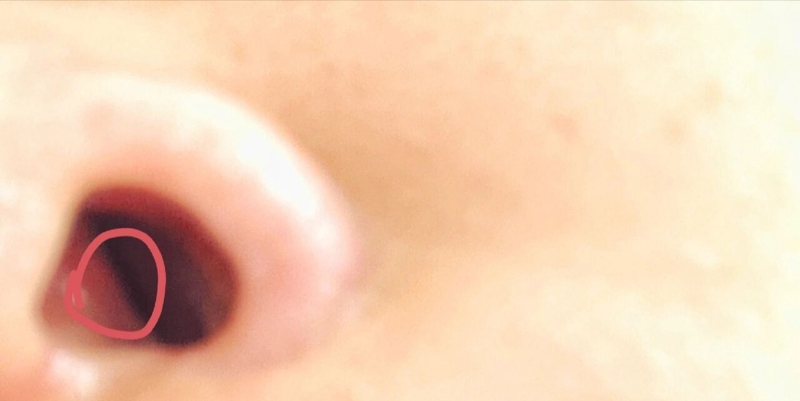 鼻子里面好像一坨软骨肿着 宝子们 有天换衣服不小心打到鼻子 咔嚓的