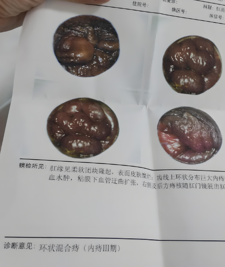 痔疮肉球的样子要看具体类型,常见的有内痔,外痔和混合痔