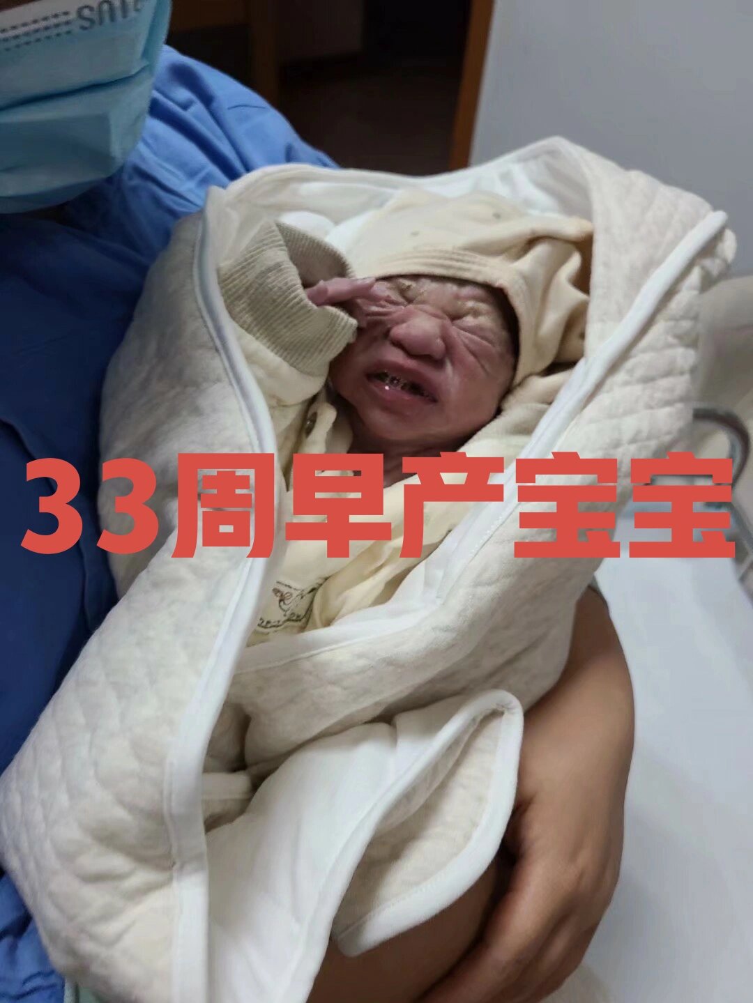 33周早产宝宝