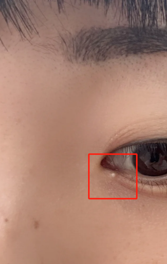 眼角长白色小点可能和戴隐形眼镜时间太长,眼睛没洗干净,粟丘疹