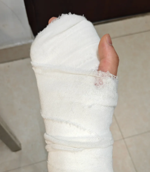 受伤后除了剧烈疼痛,还可能出现红肿出血,手指变形,软组织损伤等问题