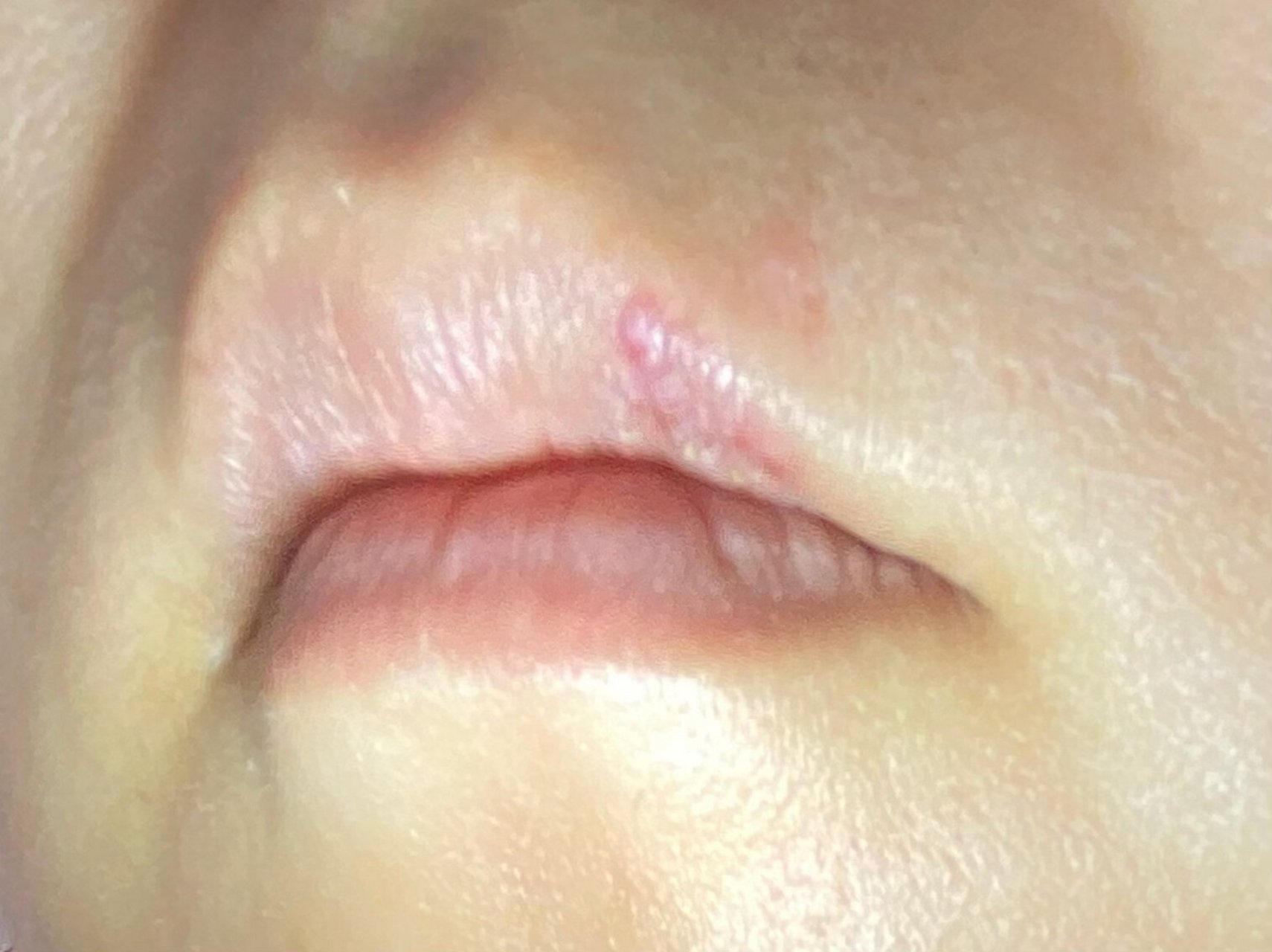 上火?唇疱疹?一招消灭! ?