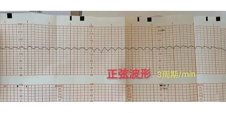 正弦波胎监 马上住院!