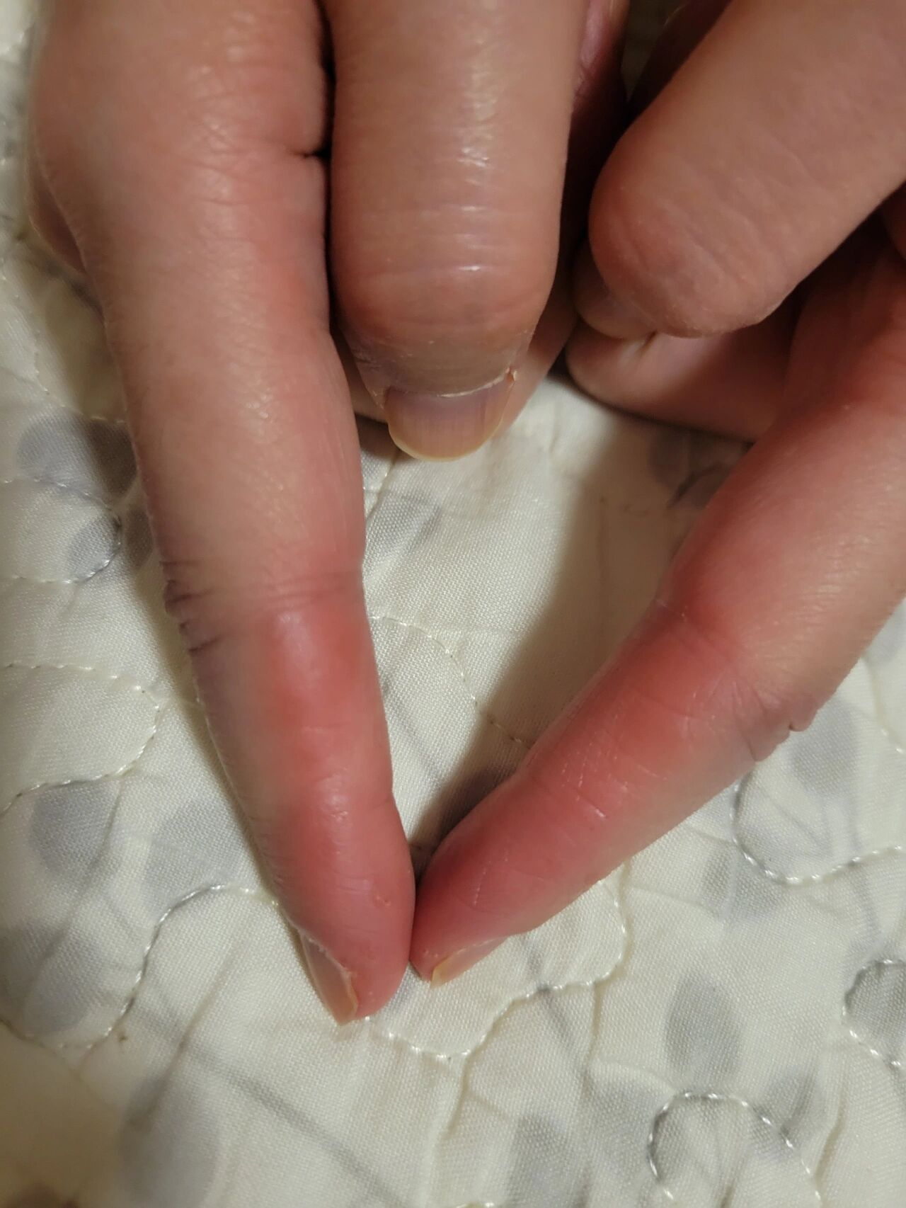 手指侧面红色疙瘩 每天手指关节肿胀,手腕也疼,去医院看的骨科,白细胞