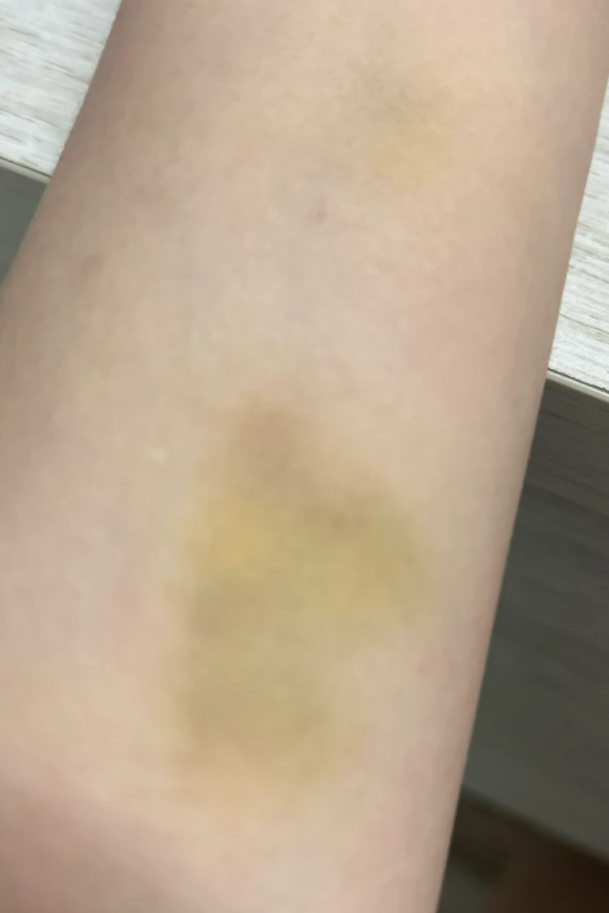 为什么身上会出现淤青