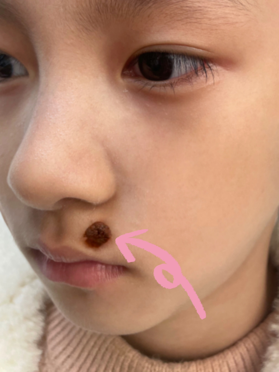 早看少遭罪! 01真的是超级后悔…没早点给妹妹切痣!u1s1!