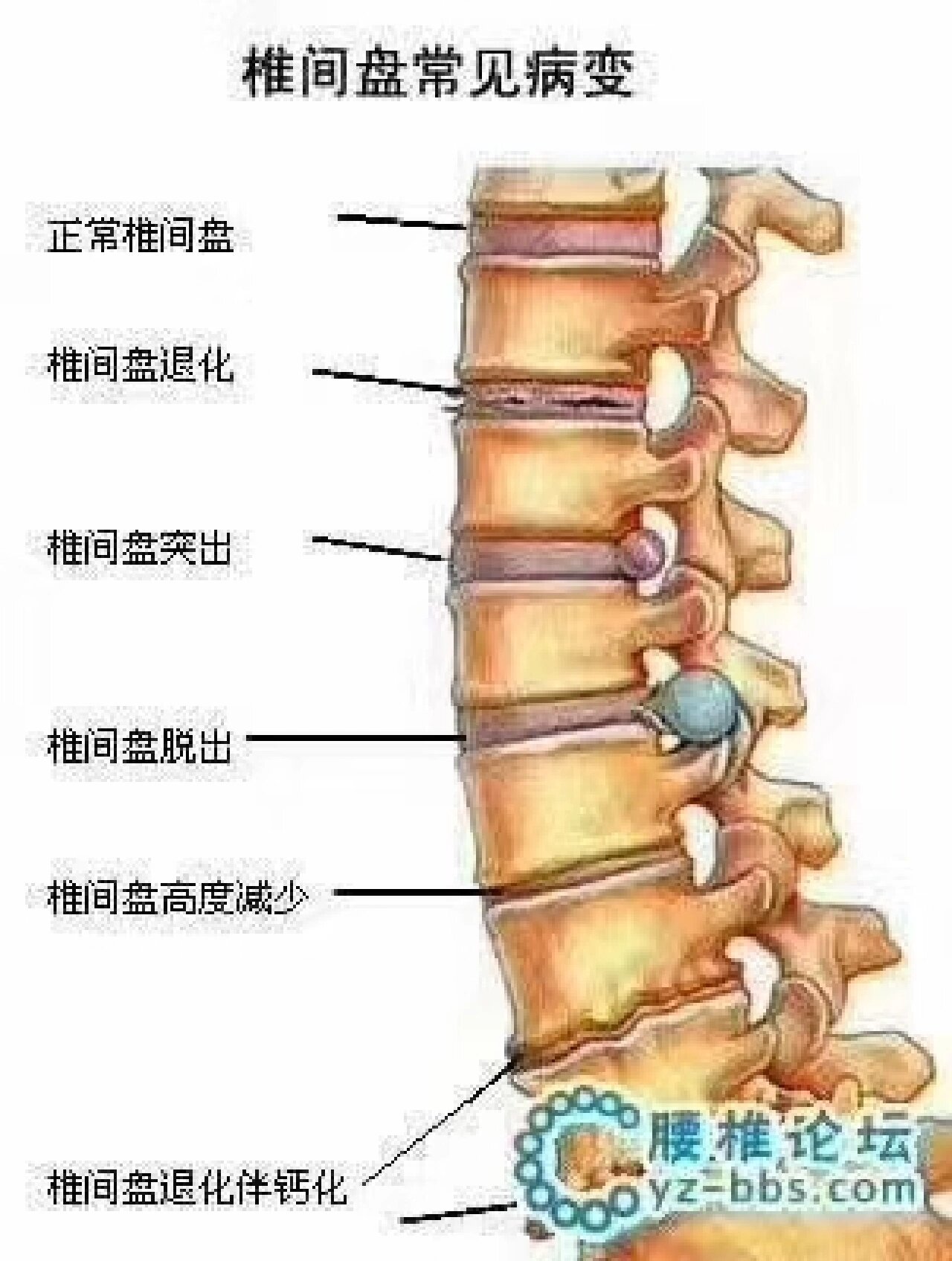 腰椎间盘突出症是较为常见的疾患之一