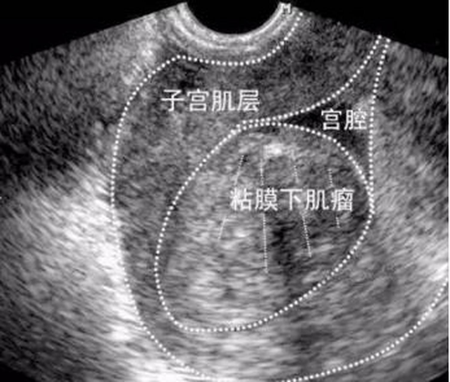 48岁 5公分黏膜下肌瘤 02需要手术吗?
