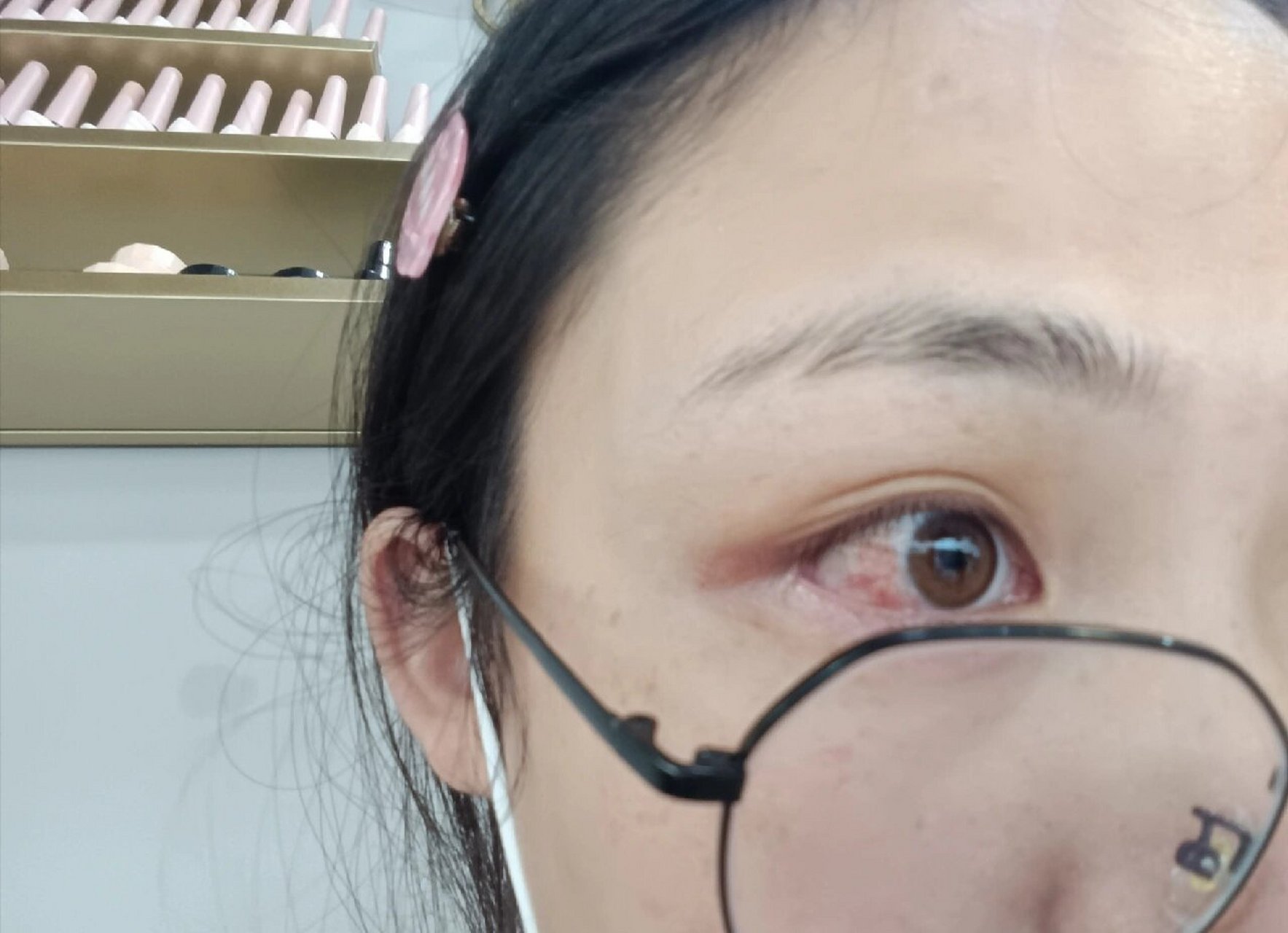 眼白色素痣 眼睛里这块色素已经很多年了,不敢跟人对视,怕别人发现,还