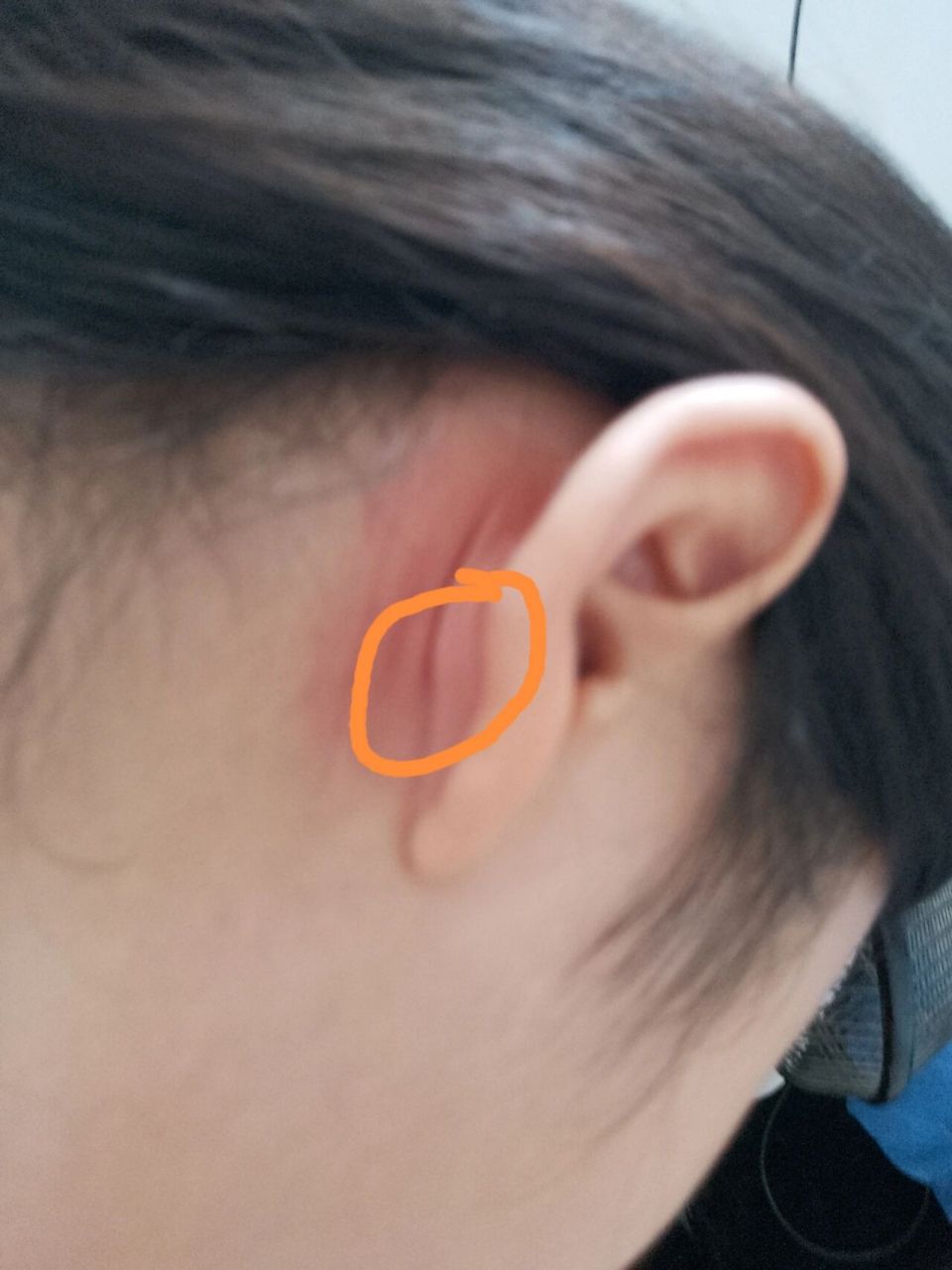 耳朵起了一个包子,一按有点疼是怎么回事啊