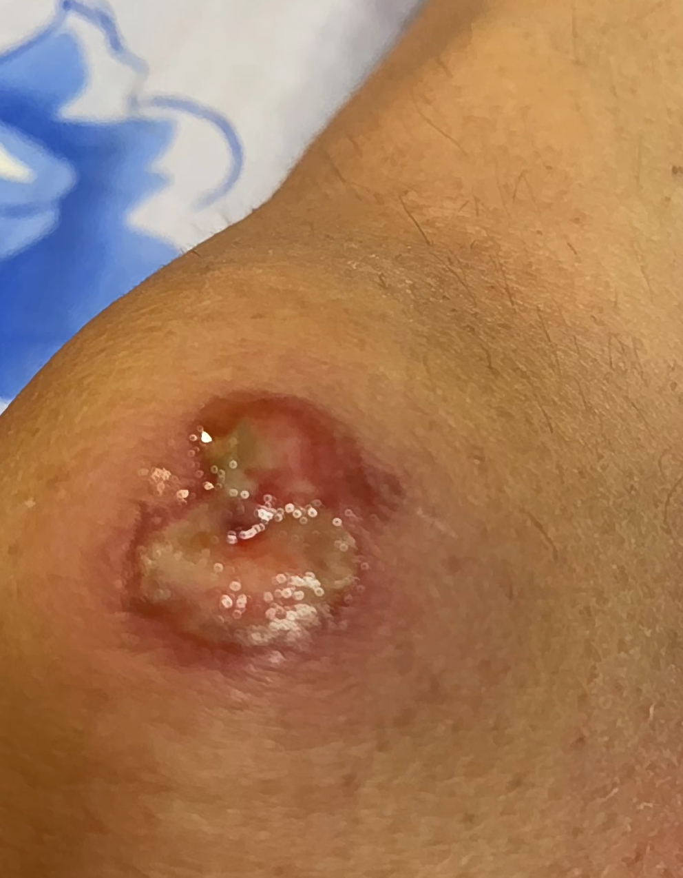 长包化脓要根据严重程度选择不同处理方法