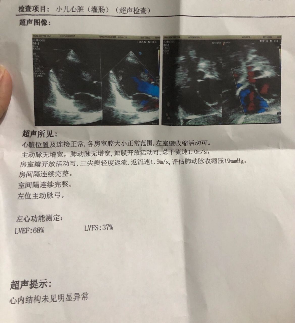 小宝宝的心脏彩超 18个月正常体检,因为就近每次都在县城内体检,这次