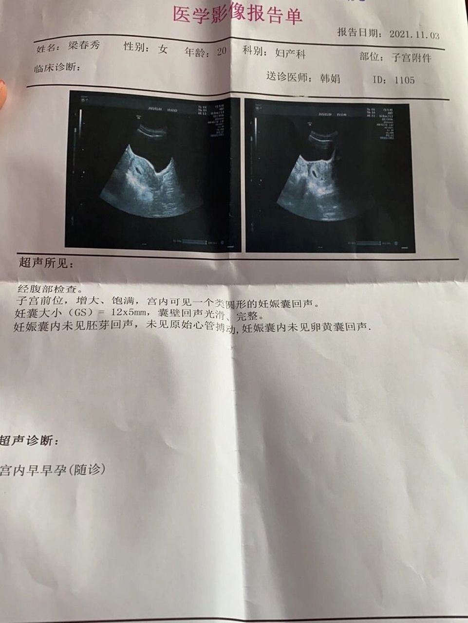 怀孕一个月左右的时候去做了彩超图,因为是输卵管通而不通自然受孕