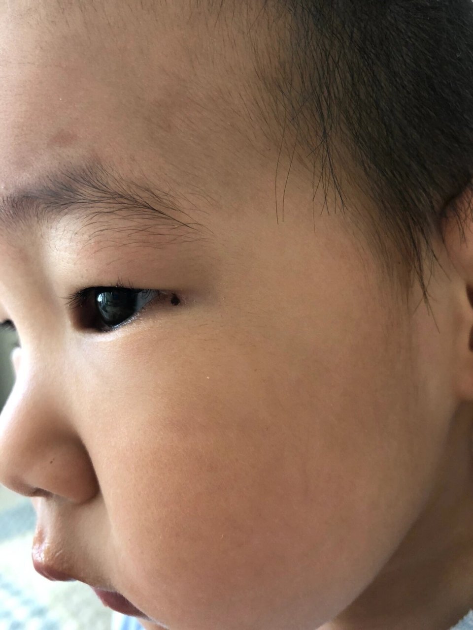 宝宝眼角的色素痣要不要处理 宝宝眼角的痦子貌似长得有点快,两张照片