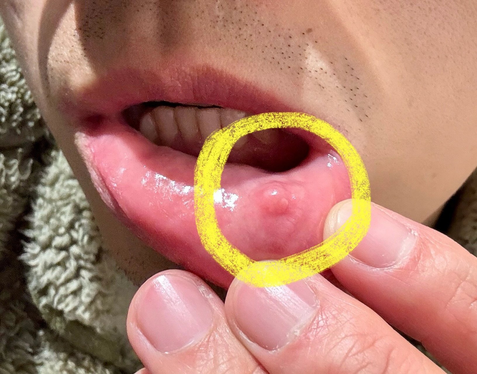 嘴唇长了硬疙瘩,有口腔专家帮忙看下吗?