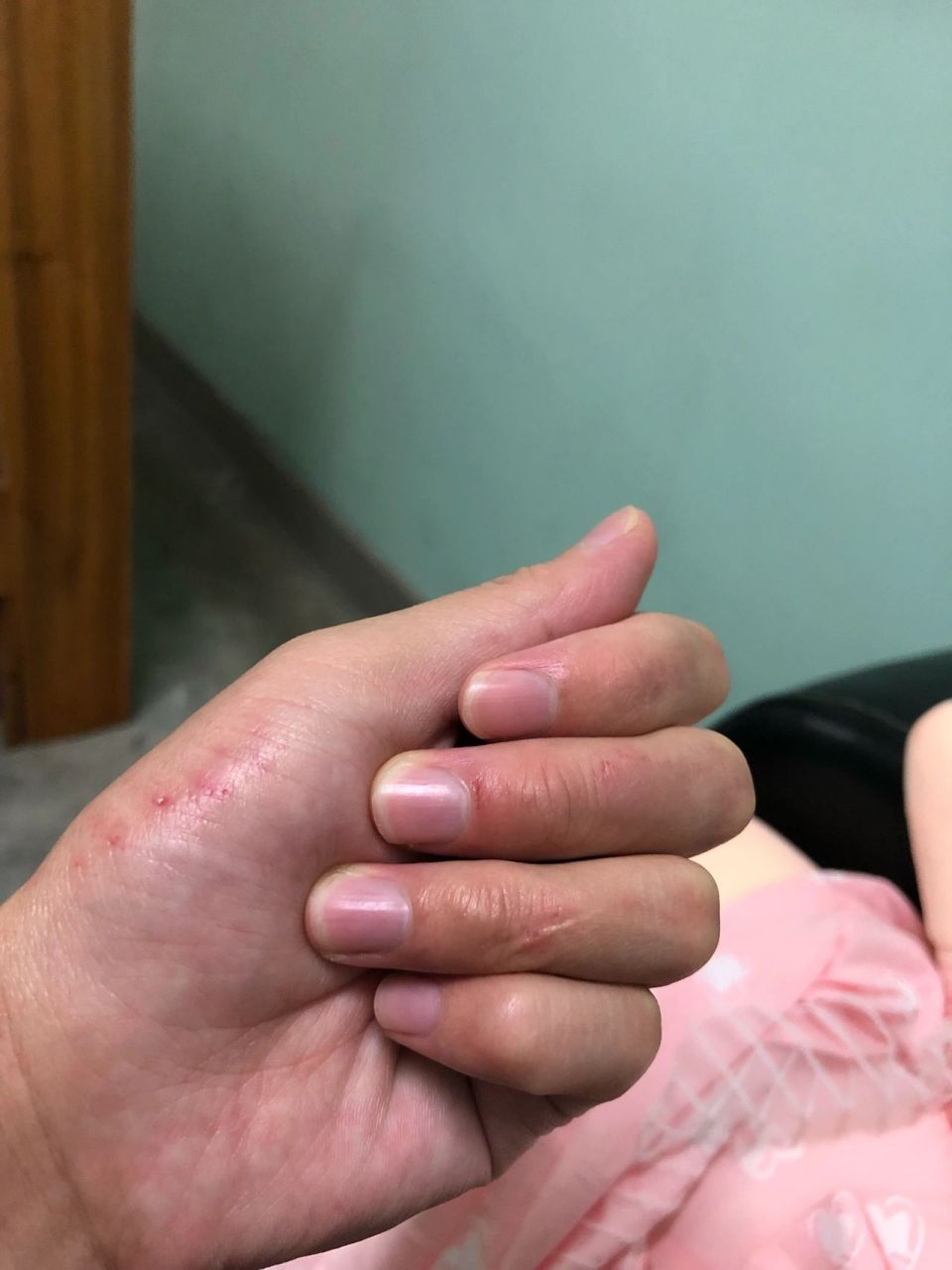 用洗衣粉真伤手 是我手皮薄还是洗衣粉的问题