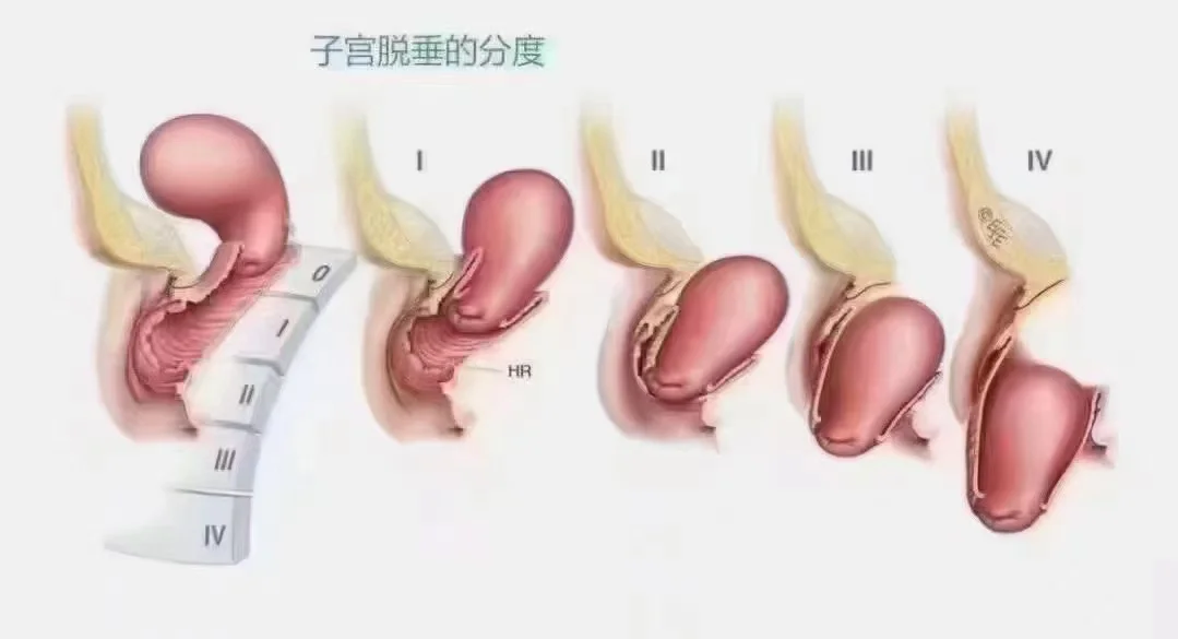 "子宫脱垂" 你能感受到的时候,说明已经很严重了.