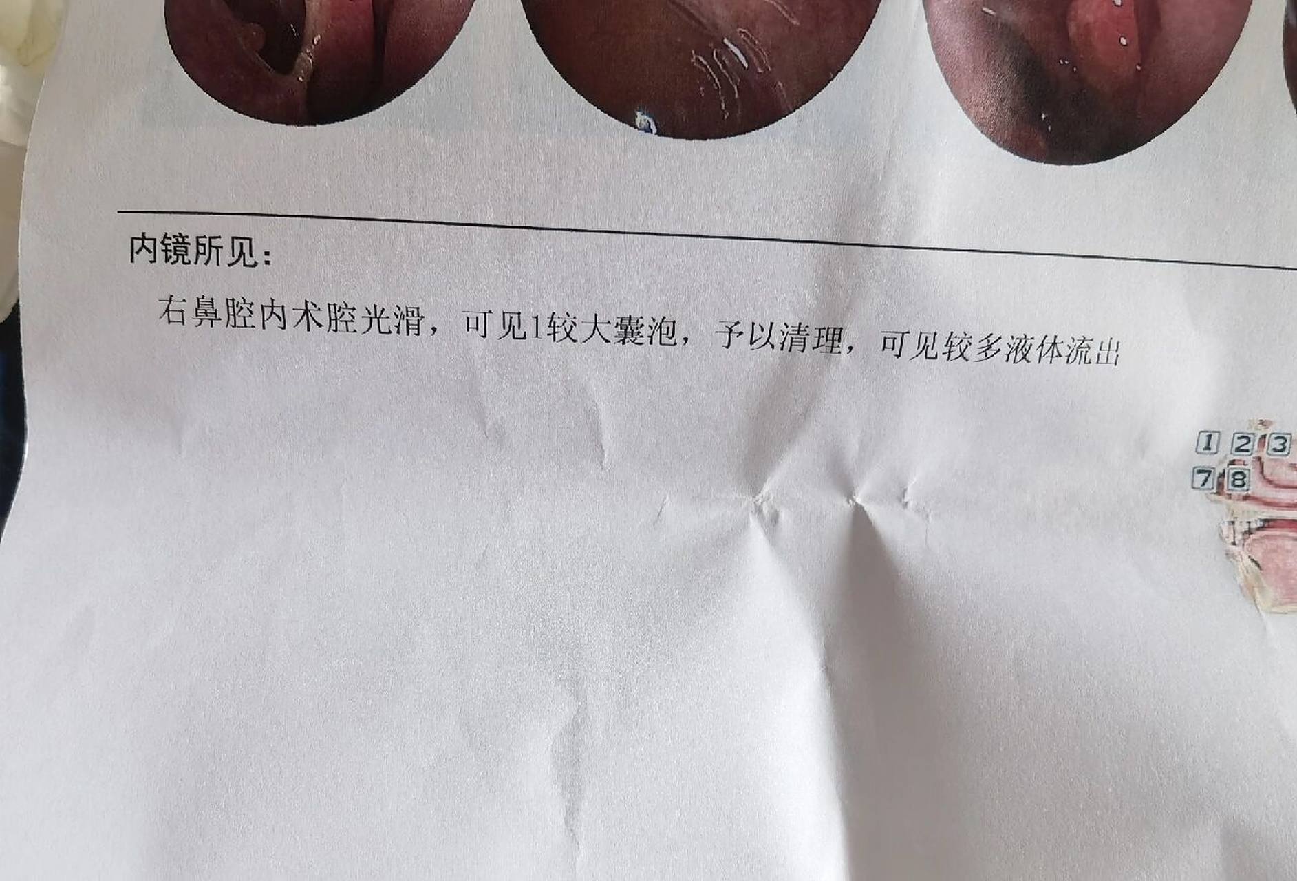 右侧上颌窦囊肿手术 三月份去做的手术,做好就封了,中间都没能去医院