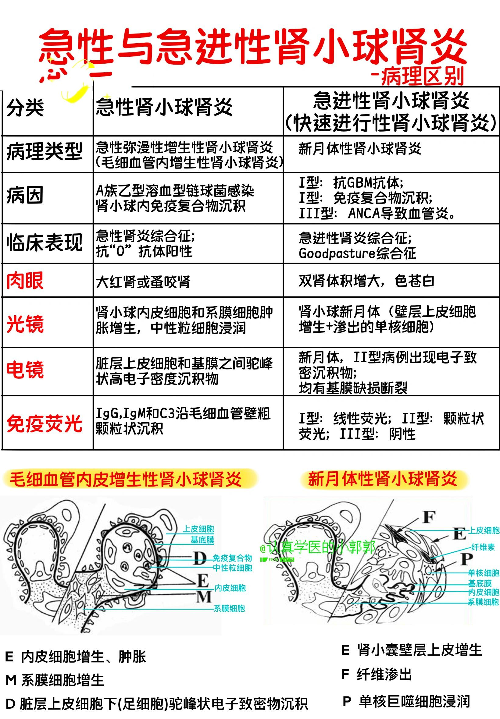 急性和急进性肾小球肾炎对比,你分清了吗?