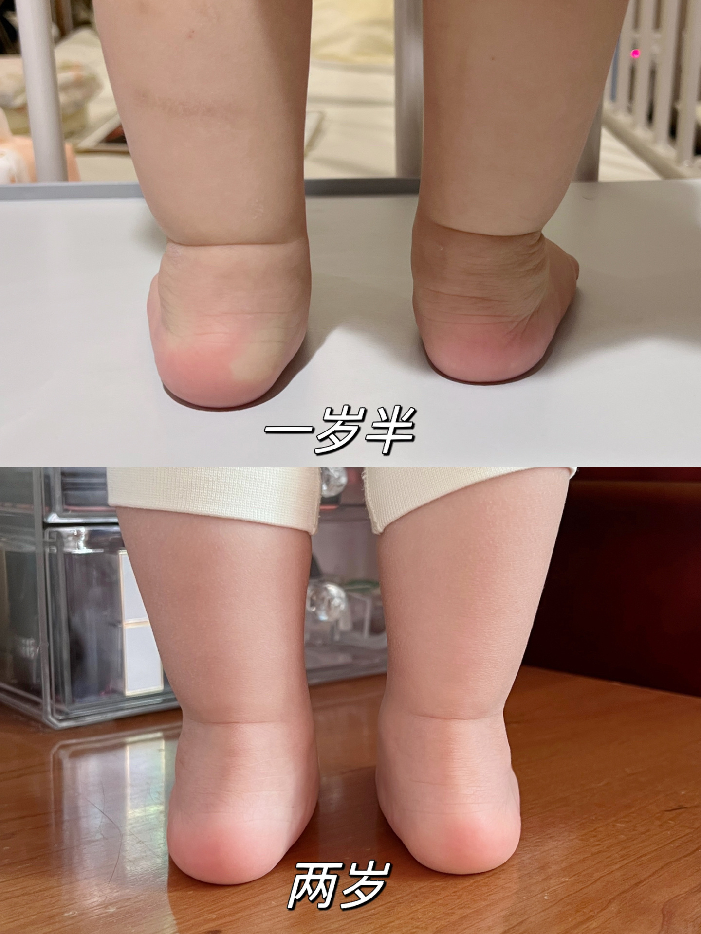 足外翻怎么矫正⁉️全篇干货 宝宝足外翻,拒绝过度焦虑,但也一定