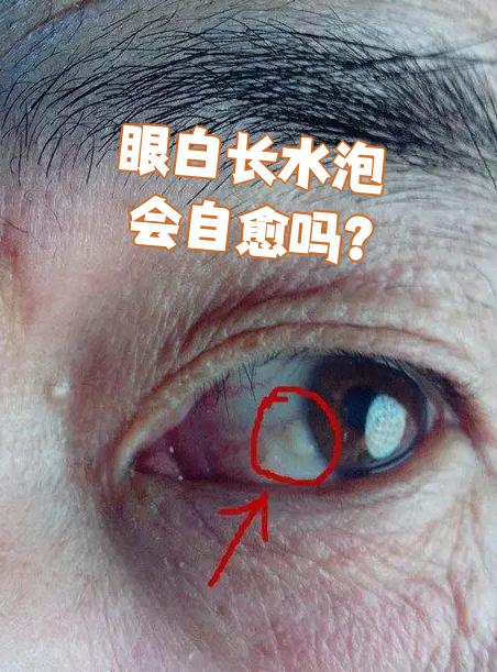 如果是结膜淋巴管堵塞,水泡通常很小,像针尖一样
