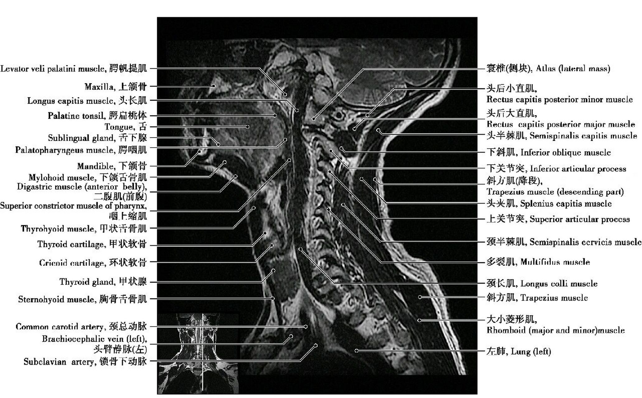 颈椎mri平扫图解图片
