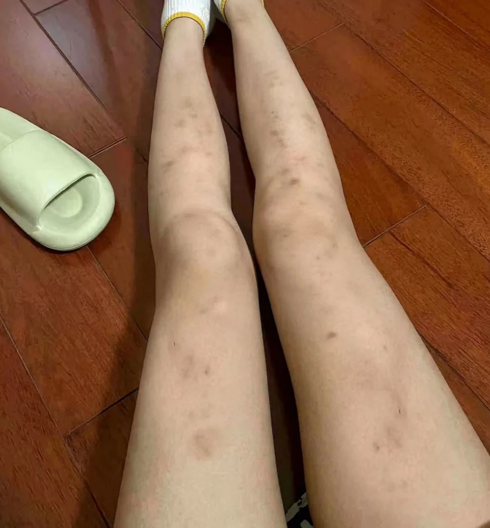 大腿根内侧出现黑色斑块,常见原因包括色素沉着,股癣和湿疹