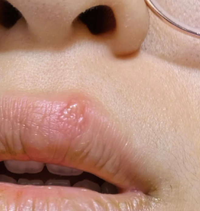 如果水疱是一堆一堆长的,而且很疼,可能是单纯疱疹病毒引起的疱疹性