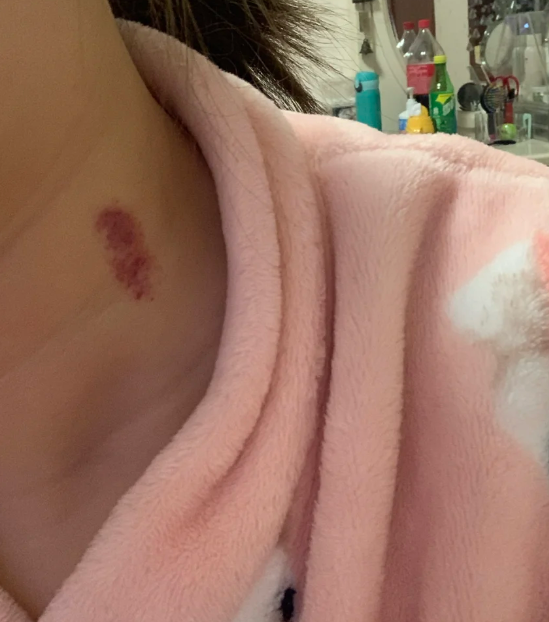 淤青草莓印怎么消除