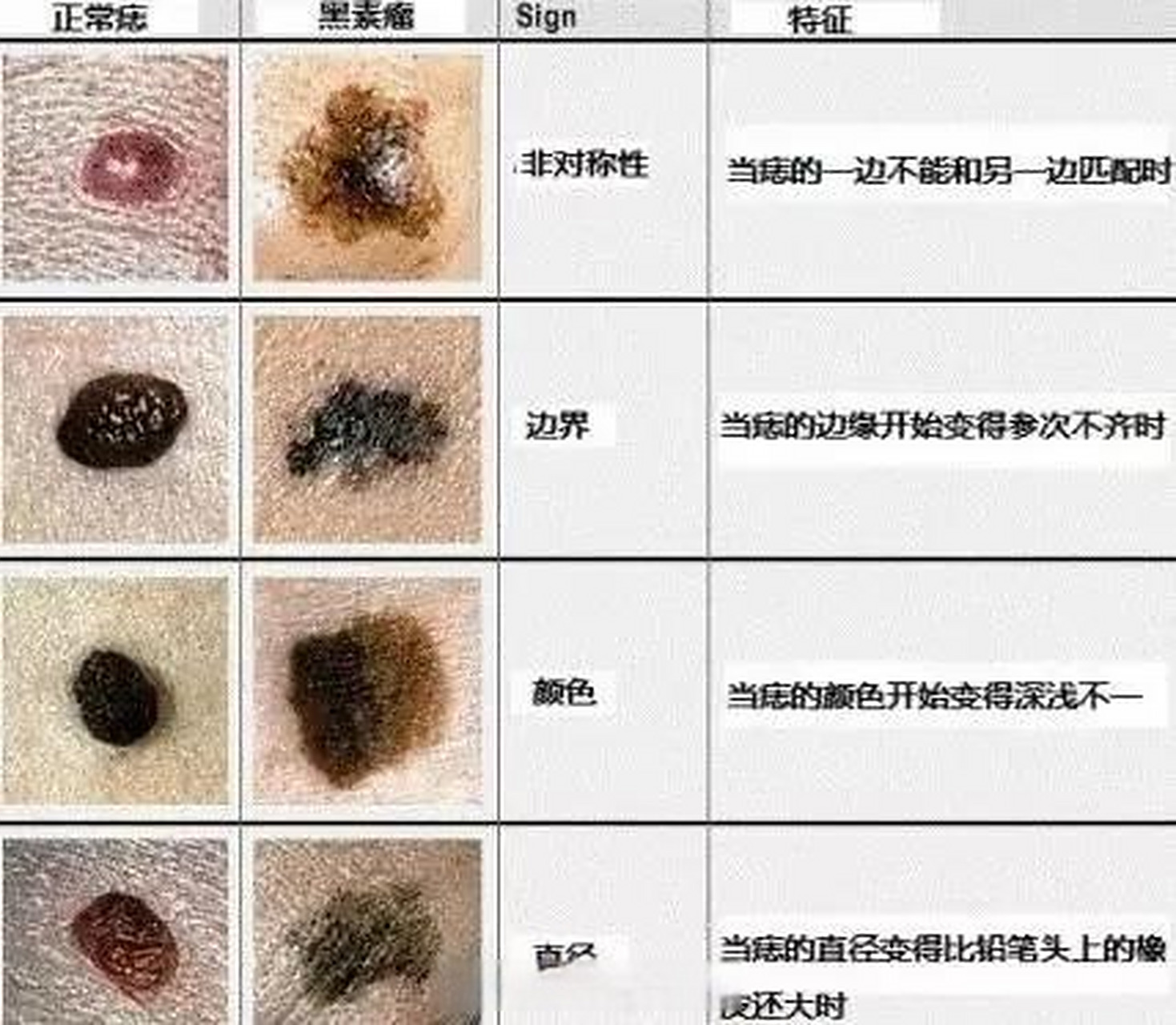如何鉴别恶性黑色素瘤和普通色素痣   一,如何区分普通痣和黑色素瘤?